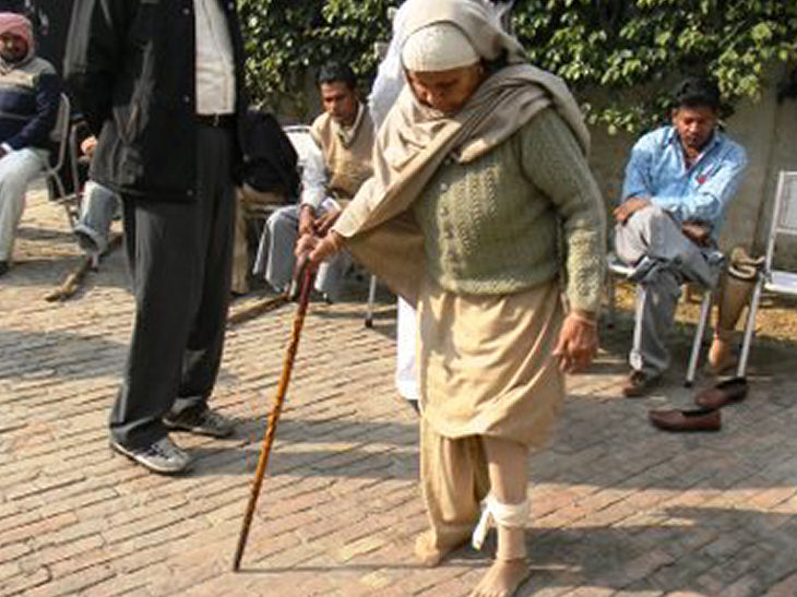 Artificial Limb beneficiary